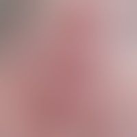 Granuloma faciale: Mann, 51... Granuloma faciale: Mann, 51 Jahre. seit 2020 ortsstabil isoliert nur rechte Schläfe sub. symptoml...