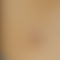 Epitheloides Hämangiom (Ang... Epitheloides Hämangiom (Angiolymphoide Hyperplasie mit Eosinophilie): festes rotes Knötchen. Abb....