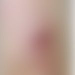 Epitheloides Hämangiom (Angiolymphoide Hyperplasie mit Eosinophilie): festes rotes Knötchen. Abb....