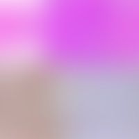 Relativ gut abgegrenzte und... Relativ gut abgegrenzte und umrandete Läsion, die unvollständig exzidiert ist (a). Eine höhere Ve...