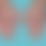 Erythema elevatum diutinum: Seit mehreren Monaten, schmerzlose erythematöse Plaques und Knoten. A...