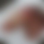 Ulcus molle: Historische Moulage. Abbildung entnommen aus: K. Zieler, Atlas der Haut- und Geschle...
