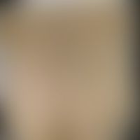Tuberkulose - Miliartuberku... Tuberkulose - Miliartuberkulose: Historische Moulage. Abbildung entnommen aus: K. Zieler, Atlas d...