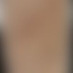 Mykid (Trichophytid)/Historische Moulage: Abbildung entnommen aus: K. Zieler, Atlas der Haut- und...