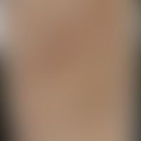 Mykid, lichenoides: Historische Moulage. Abbildung entnommen aus: K. Zieler, Atlas der Haut- und ...