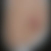 Sporotrichose/Historische M... Sporotrichose/Historische Moulage: Abbildung entnommen aus: K. Zieler, Atlas der Haut- und Geschl...