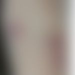 Differenzialdiagnose - Ekthyma. Diagnose: Sporotrichose. Historische Moulage. Abbildung entnommen...