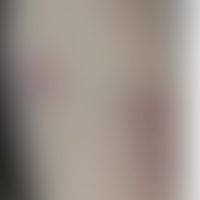 Differenzialdiagnose - Ekth... Differenzialdiagnose - Ekthyma. Diagnose: Sporotrichose. Historische Moulage. Abbildung entnommen...