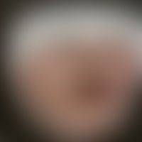Syphilis/Primäraffekt: Hist... Syphilis/Primäraffekt: Historische Moulage. Abbildung entnommen aus: K. Zieler, Atlas der Haut- u...