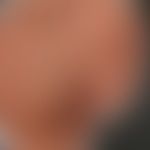 Scharlach: Historische Moulage. Abbildung entnommen aus: K. Zieler, Atlas der Haut- und Geschlech...