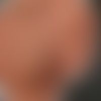 Scharlach: Historische Moul... Scharlach: Historische Moulage. Abbildung entnommen aus: K. Zieler, Atlas der Haut- und Geschlech...