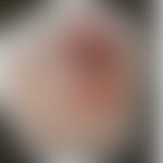 Rhinosklerom: Historische Moulage. Abbildung entnommen aus: K. Zieler, Atlas der Haut- und Geschl...