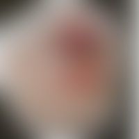 Rhinosklerom: Historische M... Rhinosklerom: Historische Moulage. Abbildung entnommen aus: K. Zieler, Atlas der Haut- und Geschl...