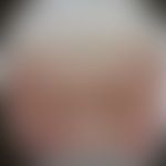 Lupus erythematodes kutaner:  Historische Moulage eines chronisch dsikoiden Lupus erythematodes. ...