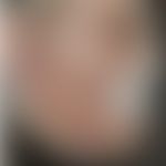 Tuberculosis cutis luposa (verrucosa): Historische Moulage. Abbildung entnommen aus: K. Zieler, A...