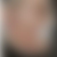 Differenzialdiagnose Tinea ... Differenzialdiagnose Tinea barbae: Diagnose: Tuberculosis cutis luposa: Historische Moulage. Abbi...