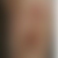 Anthrax: Historische Moulag... Anthrax: Historische Moulage. Abbildung entnommen aus: K. Zieler, Atlas der Haut- und Geschlechts...