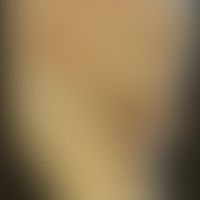 Diphtherie der Haut: Histor... Diphtherie der Haut: Historische Moulage. Abbildung entnommen aus: K. Zieler, Atlas der Haut- und...