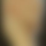 Differenzialdiganose: Pityriasis rosea - Diagnose: Diphtherie der Haut: Historische Moulage. Abbi...