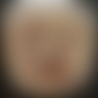 Diphtherie der Haut: Histor... Diphtherie der Haut: Historische Moulage. Abbildung entnommen aus: K. Zieler, Atlas der Haut- und...