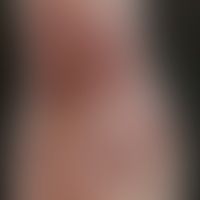Erythema multiforme minus: ... Erythema multiforme minus: Historische Moulage. Abbildung entnommen aus: K. Zieler, Atlas der Hau...