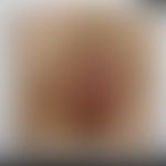 Herpes simplex genitalis: Historische Moulage. Abbildung entnommen aus: K. Zieler, Atlas der Haut...