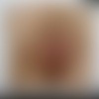 Herpes simplex genitalis: H... Herpes simplex genitalis: Historische Moulage. Abbildung entnommen aus: K. Zieler, Atlas der Haut...