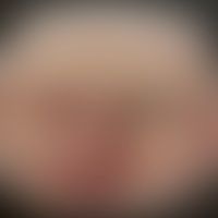 Lupus pernio: Historische Moulage. Abbildung entnommen aus: K. Zieler, Atlas der Haut- und Geschl...