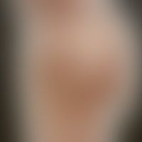 Lepra lepromatosa: Historis... Lepra lepromatosa: Historische Moulage. Abbildung entnommen aus: K. Zieler, Atlas der Haut- und G...