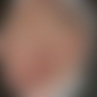 Folliculitis barbae: Histor... Folliculitis barbae: Historische Moulage. Abbildung entnommen aus: K. Zieler, Atlas der Haut- und...