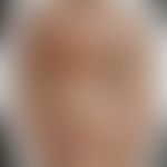 Impetigo contagiosa: Historische Moulage. Abbildung entnommen aus: K. Zieler, Atlas der Haut- und...