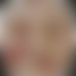 Impetigo contagiosa: Historische Moulage. Abbildung entnommen aus: K. Zieler, Atlas der Haut- und...
