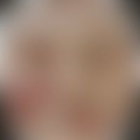 Impetigo contagiosa: Histor... Impetigo contagiosa: Historische Moulage. Abbildung entnommen aus: K. Zieler, Atlas der Haut- und...