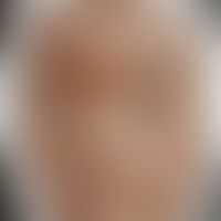 Impetigo contagiosa: Histo... Impetigo contagiosa: Historische Moulage. Abbildung entnommen aus: K. Zieler, Atlas der Haut- un...
