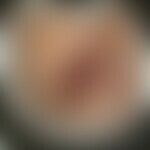Gumma als Zeichen einer Spätsyphilis: Historische Moulage. Abbildung entnommen aus: K. Zieler, At...