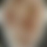 Syphilis maligna: Historische Moulage. Abbildung entnommen aus: K. Zieler, Atlas der Haut- und Ge...
