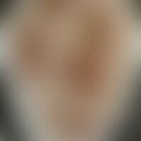 Syphilis maligna: Historisc... Syphilis maligna: Historische Moulage. Abbildung entnommen aus: K. Zieler, Atlas der Haut- und Ge...