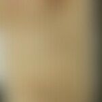  Varioliformes Syphilid: Historische Moulage. Abbildung entnommen aus: K. Zieler, Atlas der Haut-...