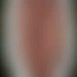 Syphilis gummosa linguae: Historische Moulage. Abbildung entnommen aus: K. Zieler, Atlas der Haut...