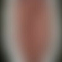 Syphilis gummosa linguae: H... Syphilis gummosa linguae: Historische Moulage. Abbildung entnommen aus: K. Zieler, Atlas der Haut...