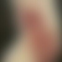 Syphilitische Gummen: Histo... Syphilitische Gummen: Historische Moulage. Abbildung entnommen aus: K. Zieler, Atlas der Haut- un...