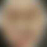 Syphilis maligna: Historische Moulage. Abbildung entnommen aus: K. Zieler, Atlas der Haut- und Ge...