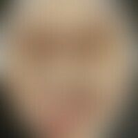 Syphilis maligna: Historisc... Syphilis maligna: Historische Moulage. Abbildung entnommen aus: K. Zieler, Atlas der Haut- und Ge...