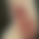 Differenzialdiagnose Mycosis fungoides: Syphilitische Gummen.Historische Moulage. Abbildung entno...