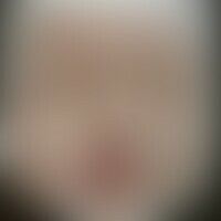 Syphilis connata: Historisc... Syphilis connata: Historische Moulage. Abbildung entnommen aus: K. Zieler, Atlas der Haut- und Ge...