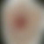 Syphilitische Gummen: Historische Moulage. Abbildung entnommen aus: K. Zieler, Atlas der Haut- un...