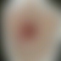 Syphilitische Gummen: Histo... Syphilitische Gummen: Historische Moulage. Abbildung entnommen aus: K. Zieler, Atlas der Haut- un...