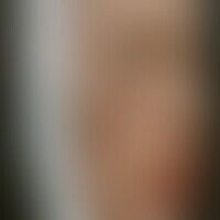 Syphilis connata: Sattelnas... Syphilis connata: Sattelnase - Historische Moulage. Abbildung entnommen aus: K. Zieler, Atlas der...