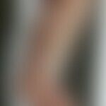 Differentialdiagnose Pemphigoide: Syphilis pemphigoides des Säuglings: Historische Moulage. Abbil...