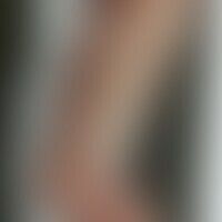 Differentialdiagnose Pemphi... Differentialdiagnose Pemphigoide: Syphilis pemphigoides des Säuglings: Historische Moulage. Abbil...